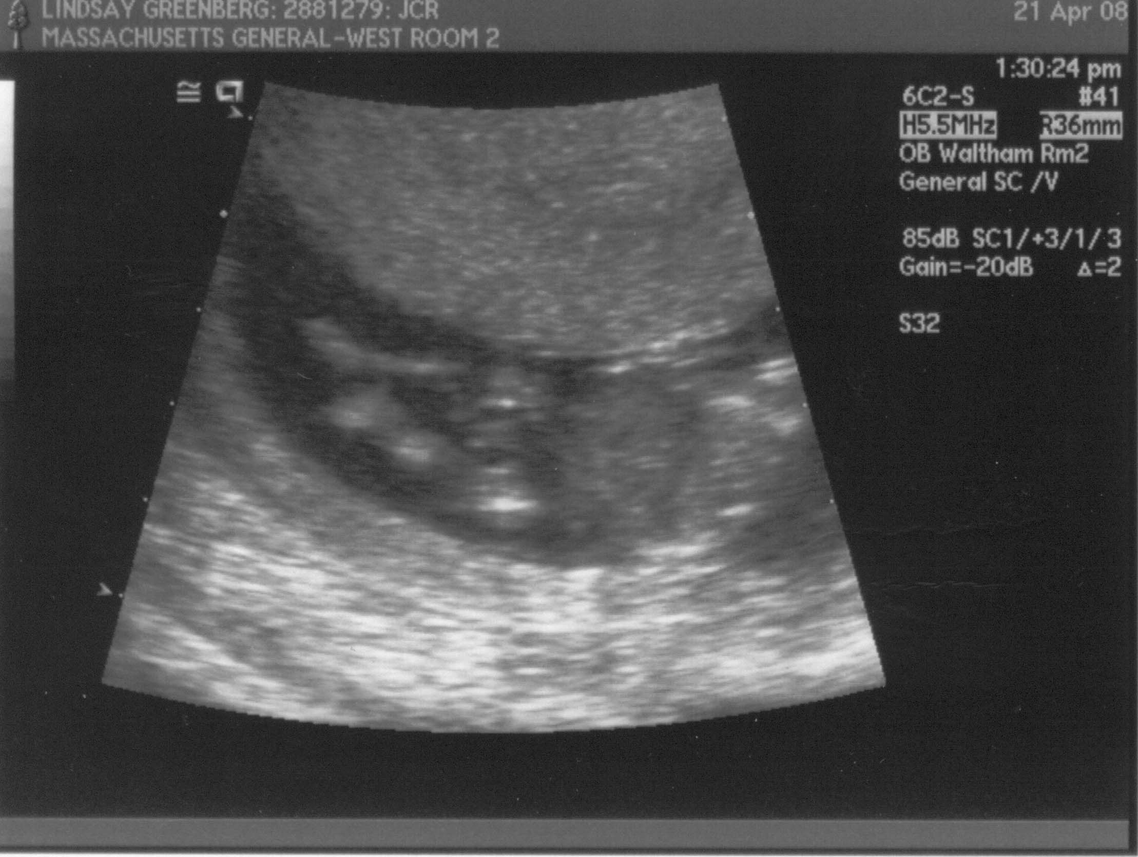 ultrasound - 2008-04-21 (12 week) - 1.jpg