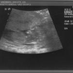 ultrasound - 2008-04-21 (12 week) - 2.jpg