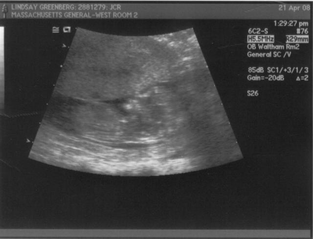 ultrasound - 2008-04-21 (12 week) - 2.jpg