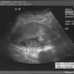 ultrasound - 2008-04-21 (12 week) - 3.jpg