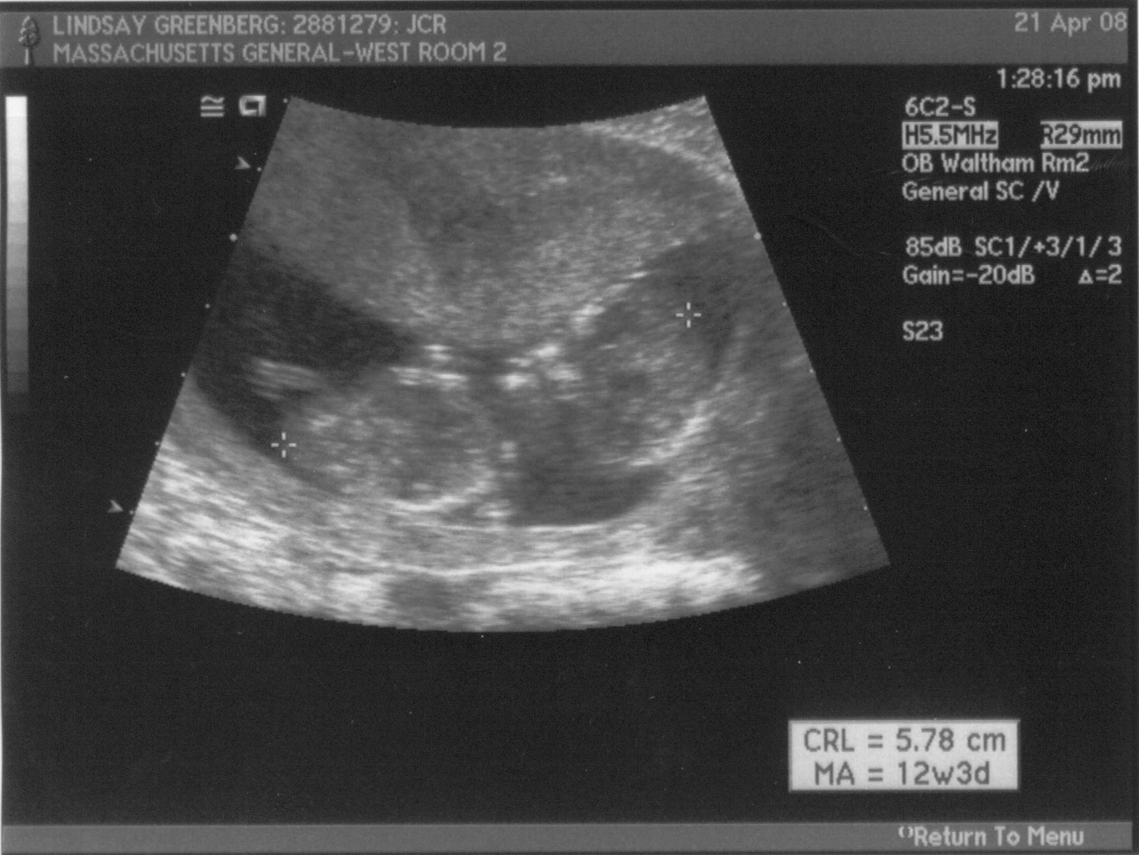 ultrasound - 2008-04-21 (12 week) - 4.jpg