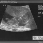 ultrasound - 2008-04-21 (12 week) - 4.jpg