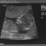 ultrasound - 2008-04-21 (12 week) - 5.jpg