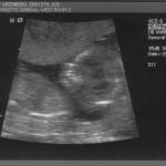 ultrasound - 2008-04-21 (12 week) - 6.jpg