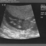 Ultrasound - 2008-04-21 (12 weeks)