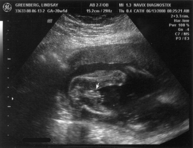 ultrasound - 2008-06-13 (20 week) - 4.jpg