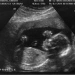 Ultrasound 3 - 2008-06-13 (20 weeks)