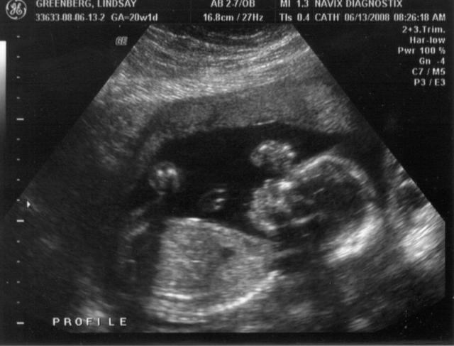 ultrasound - 2008-06-13 (20 week) - 1.jpg