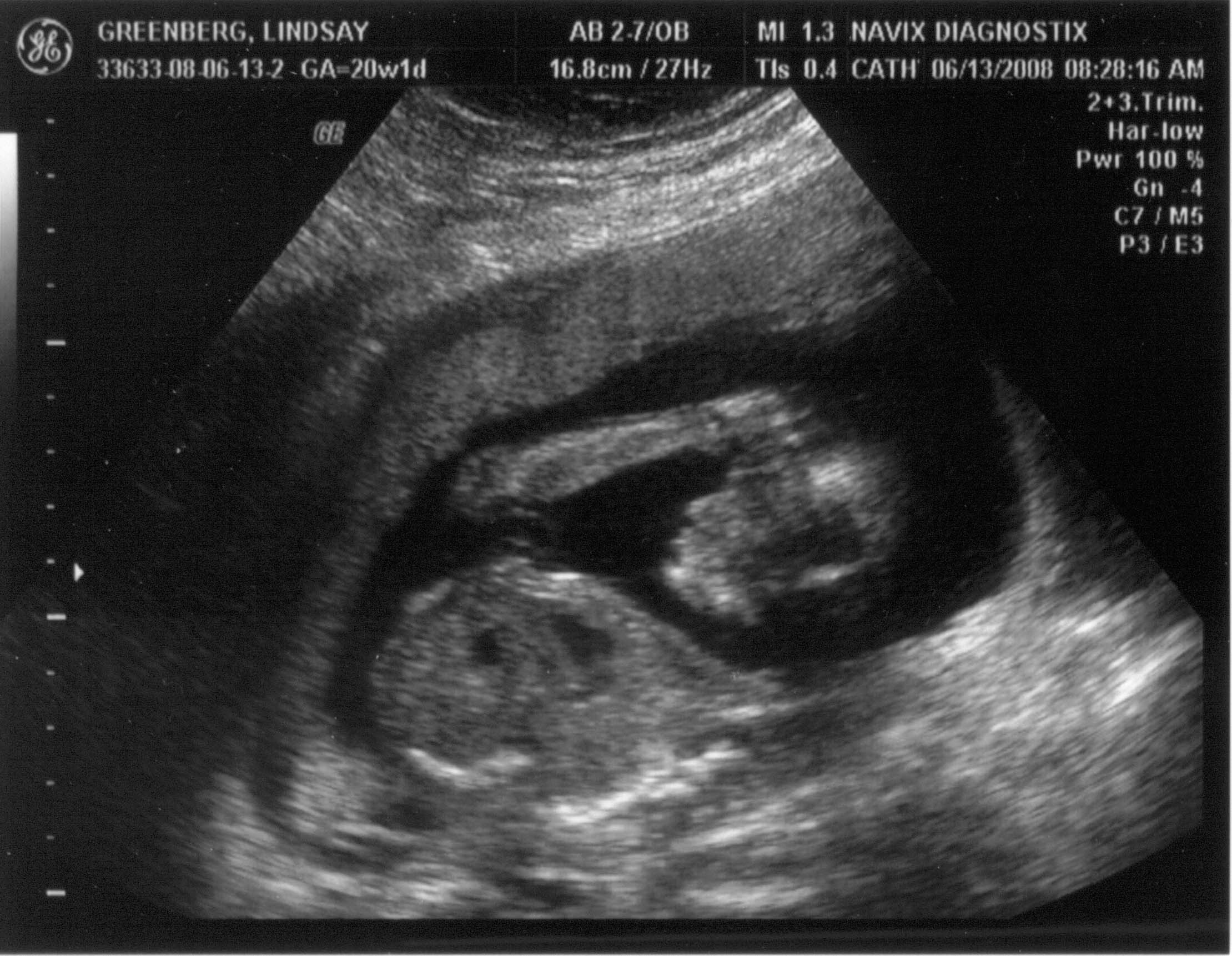 ultrasound - 2008-06-13 (20 week) - 2.jpg