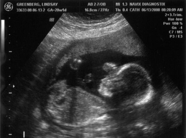ultrasound - 2008-06-13 (20 week) - 3.jpg