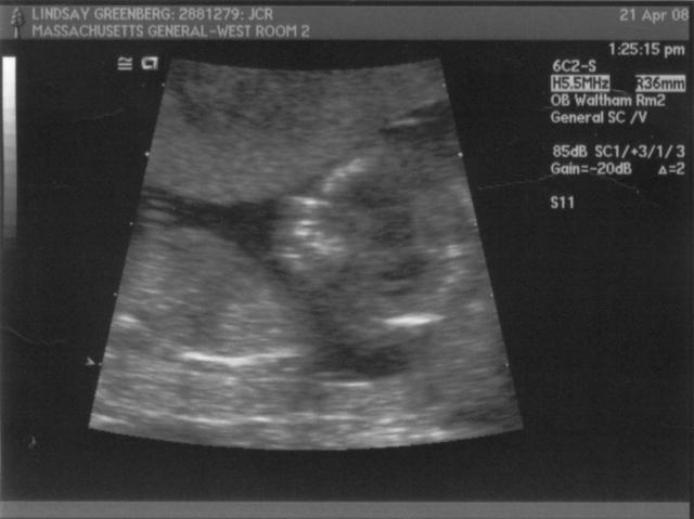 ultrasound - 2008-04-21 (12 week) - 6.jpg
